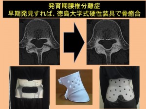 発育期腰椎分離症 早期発見すれば、徳島大学式硬性装具で骨癒合