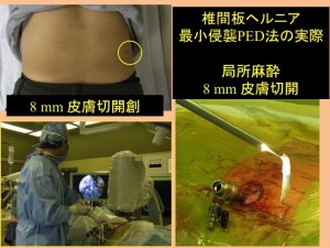 椎間板ヘルニア 最小侵襲PEDの実際 局所麻酔、8mmの皮膚切開